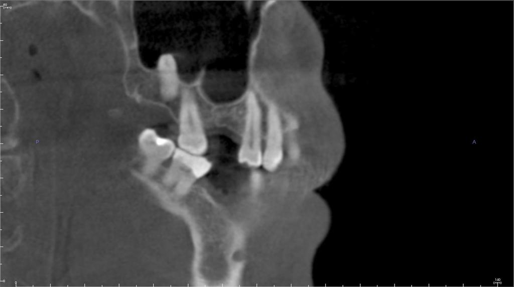 Images Figure 1 #14 extraction site with maxillary sinus