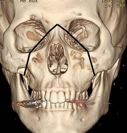 All walls of maxillary sinus involved Inferior orbital