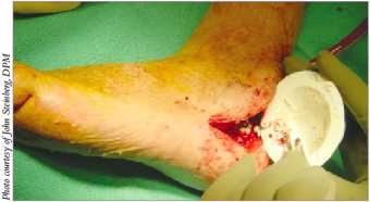 Vancomycin-impregnated calcium sulpfate tx for DM foot ulceration Benefit: Direct target of infected