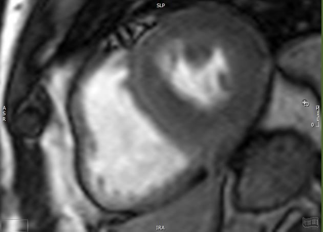 Strain: MRI Technique, Pearls & Pitfalls Image Selection Use series composer tool to