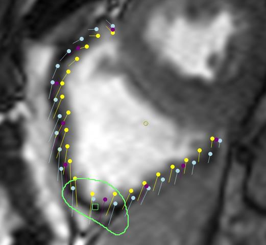 Strain: MRI Technique, Pearls & Pitfalls Quality Assurance If the boundary points move too far in, and end up in the blood pool at systole (green circle), then the