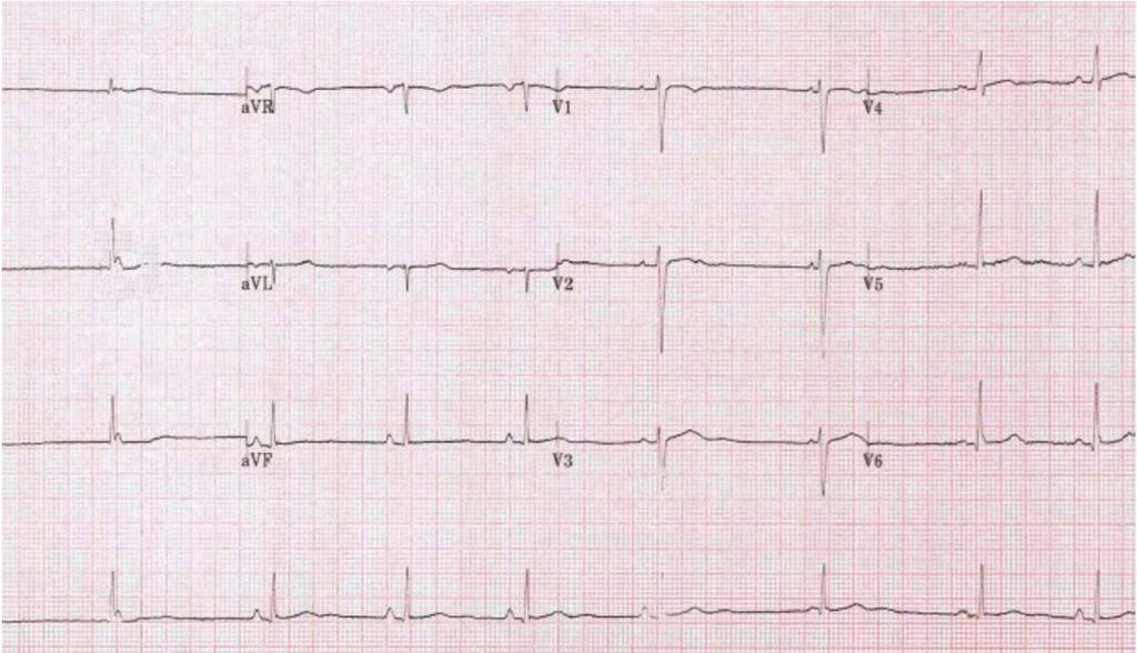 Clinical Case 34 YEAR OLD FEMALE 1st trimester of pregnancy Exertional syncope Extensive exercise