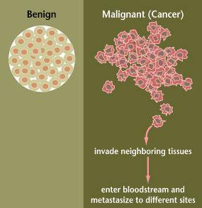 #15. Malignant versus benign tumours Benign does not spread. Malignant tumors will spread. (Metastasis Terms of cancer #17 Define Carcinogen Answer: A substance that causes cancer.