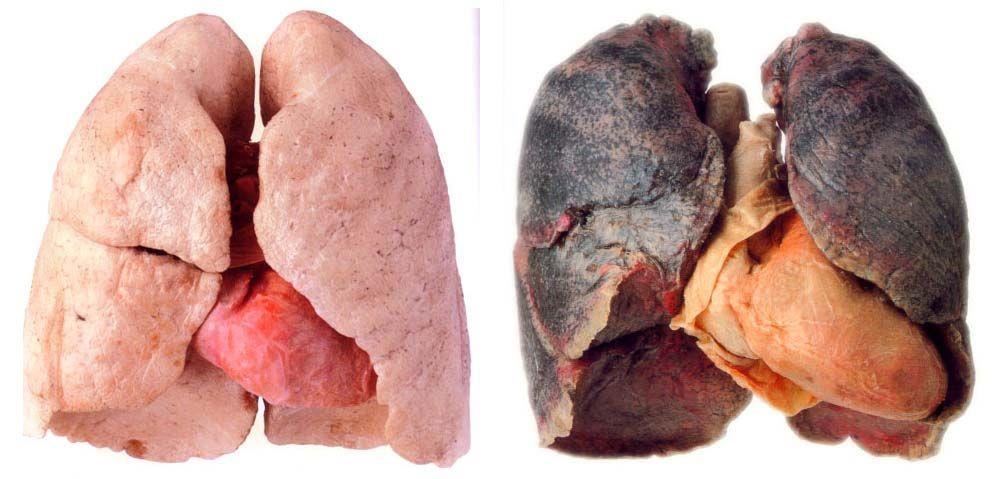 Effects of Smoking #3 What happens to the alveoli sacs when the chemicals melt