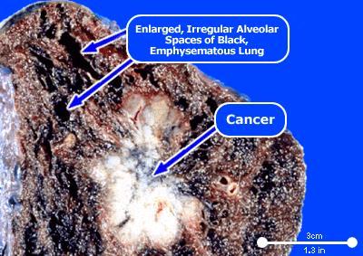After years of smoking or second hand smoke the alveoli get filled with tars