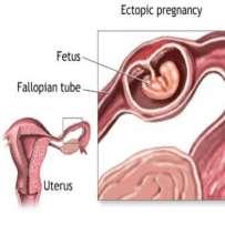 html Placenta Danger of an Out-of-place pregnancy = only uterus &