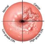 HPV human papilloma virus. Present in 50% of sexually active adult population.
