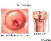 Vaginal warts Cervical cancer stages Cervical warts Oral/throat cancer?