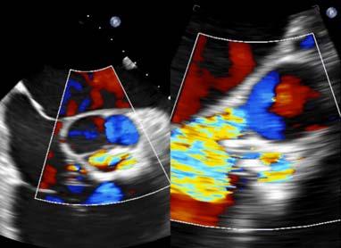 Cause of Acute Severe Aortic Dissection Dissection with disruption of the valve commissures Endocarditis Chest trauma Acute