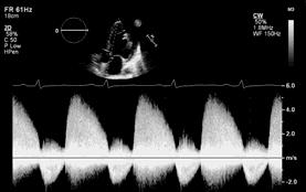 Diastolic Opening of the Aortic
