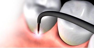 --Laser-assisted New Attachment Procedure (LANAP)-- For persons dealing with periodontal gum disease the process for finding a solution can be very frustrating, time consuming and costly.