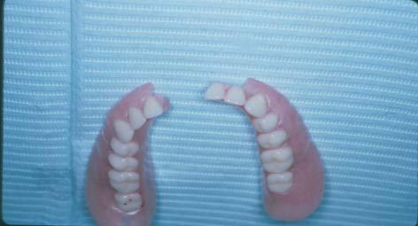 Broken or Loose Dentures Broken dentures should be repaired Dentures that are loose should be professionally relined Do not place loose