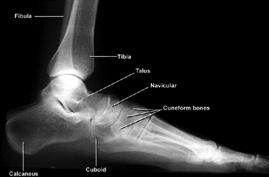 Physical Exam Metatarsal Fractures l Usually swelling around fracture site and often into entire foot