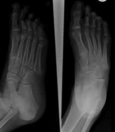 foot, into toes and on medial and lateral sides of the foot l May have limp, may or may not be able to