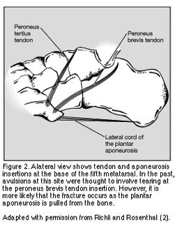 Avulsion Fractures of the 5 th MT Avulsion Fracture of the 5 th MT