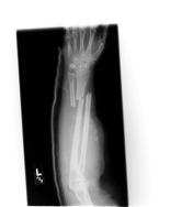 So, tell us: l Name of broken bone and general area l Is it displaced?
