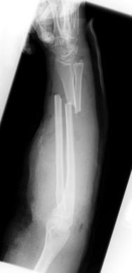 fractures of both the radius and ulna at the junction of the distal 1/3 and middle shaft