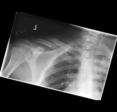 Axillary Midshaft Fracture