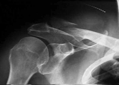 injury CYA Discuss possibility of nonuion (up to 30% in shortened, significantly displaced fracture) with patients l It s ok to take the wait and