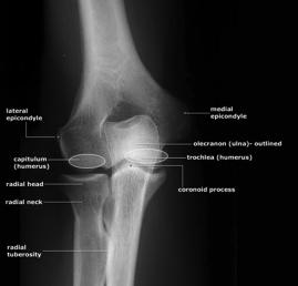 Xrays Isolated Radial Head Fractures l AP, Lateral and Radial Head views Always consider radial head