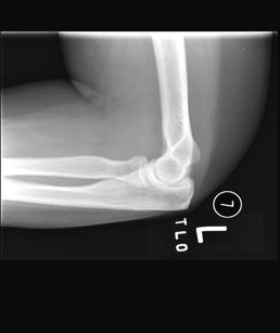 often see in a primary care setting is a non displaced fracture (to the right) Isolated Radial Head