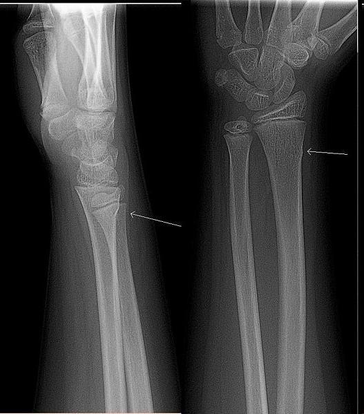 Fracture Types Greenstick Greenstick: common in children, incomplete fracture Colles: s shaped fracture of the radius,