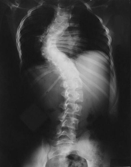 Curvature of the Spinal Column Kyphosis, scoliosis, and lordosis Treated with