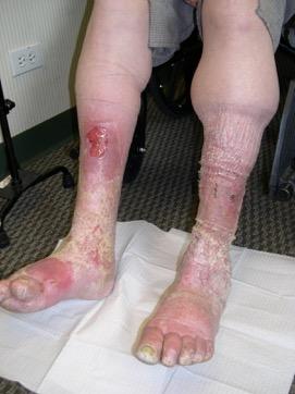Edema Is the abnormal accumulation of fluid in certain tissues within the body.