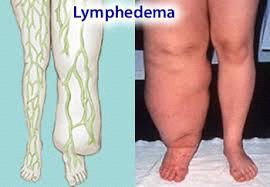 such as the legs Lymphedema Involves blockage of the lymph vessels, with a