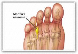 Morton s Neuroma Painful