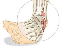 Sprain An injury to a ligament as a result of