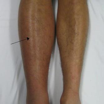 vein that usually develops