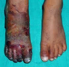 Dry Gangrene A result of loss of blood supply from arterial obstruction in