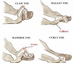 Claw Toe Hyperextension and subluxation of a metatarsophalangeal joint, with flexion deformity of the interphalangeal joints and transfer of weight-bearing to the metatarsal head Mallet Toe A flexion