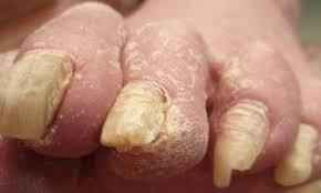 Onychomycosis Is a fungal infection