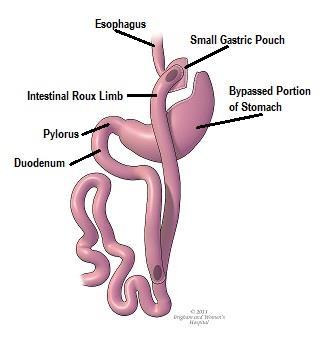 Surgeries Offered Roux-en-Y Gastric Bypass The Roux-En-Y gastric bypass is performed laparoscopically through 5-6 small incisions and takes about 90 minutes to perform.