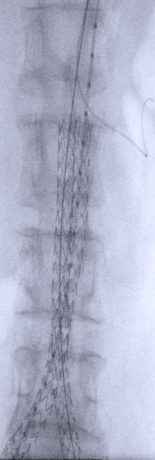 1. After Angiogram to identified type Ia endoleak, wire insertion to abdominal aorta via Lt. CFA and brachial a. 2.