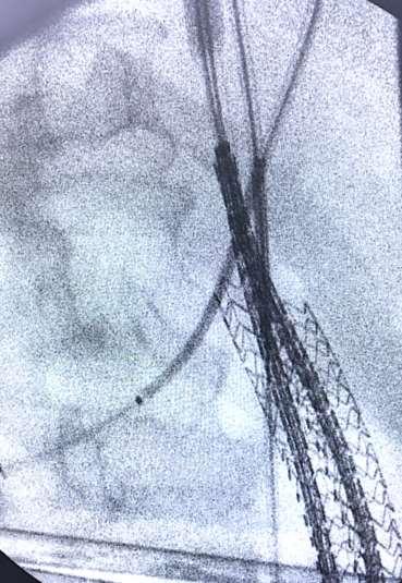 Ch-EVAS with proximal extension by Nellix-in-Nellix 1. Bilateral insertion of 100 mm Nellix stent grafts via CFA. 2.