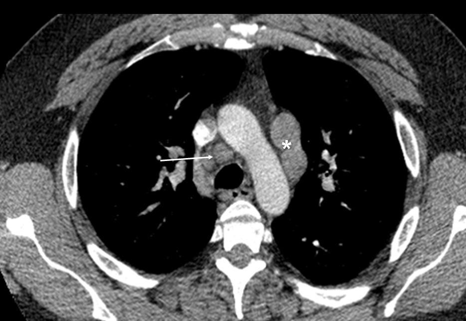a mass with irregular margins (asterisk) in the peripheral portion of the right upper lobe along the chest wall. Note the age-related calcification in the aortic arch.