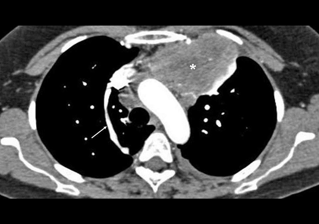 Figure 4. Contrast-enhanced CT of the chest of an 18-year-old shows a large anterior mediastinal mass (asterisk), which was subsequently diagnosed to be a germ cell tumour.