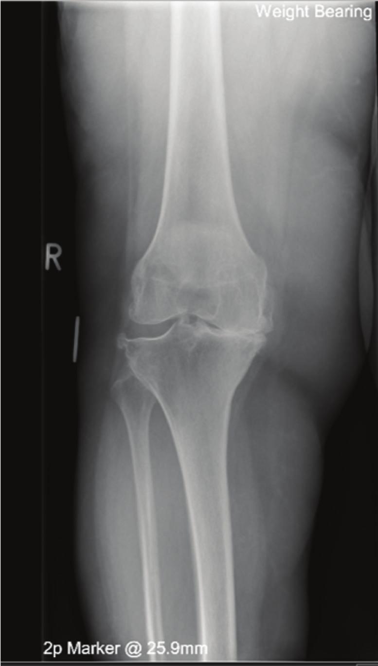 2 Case Reports in Orthopedics Figure 1: Preoperative weight-bearing AP and lateral radiographs clearly showing tricompartmental knee OA (K-L Grade IV).