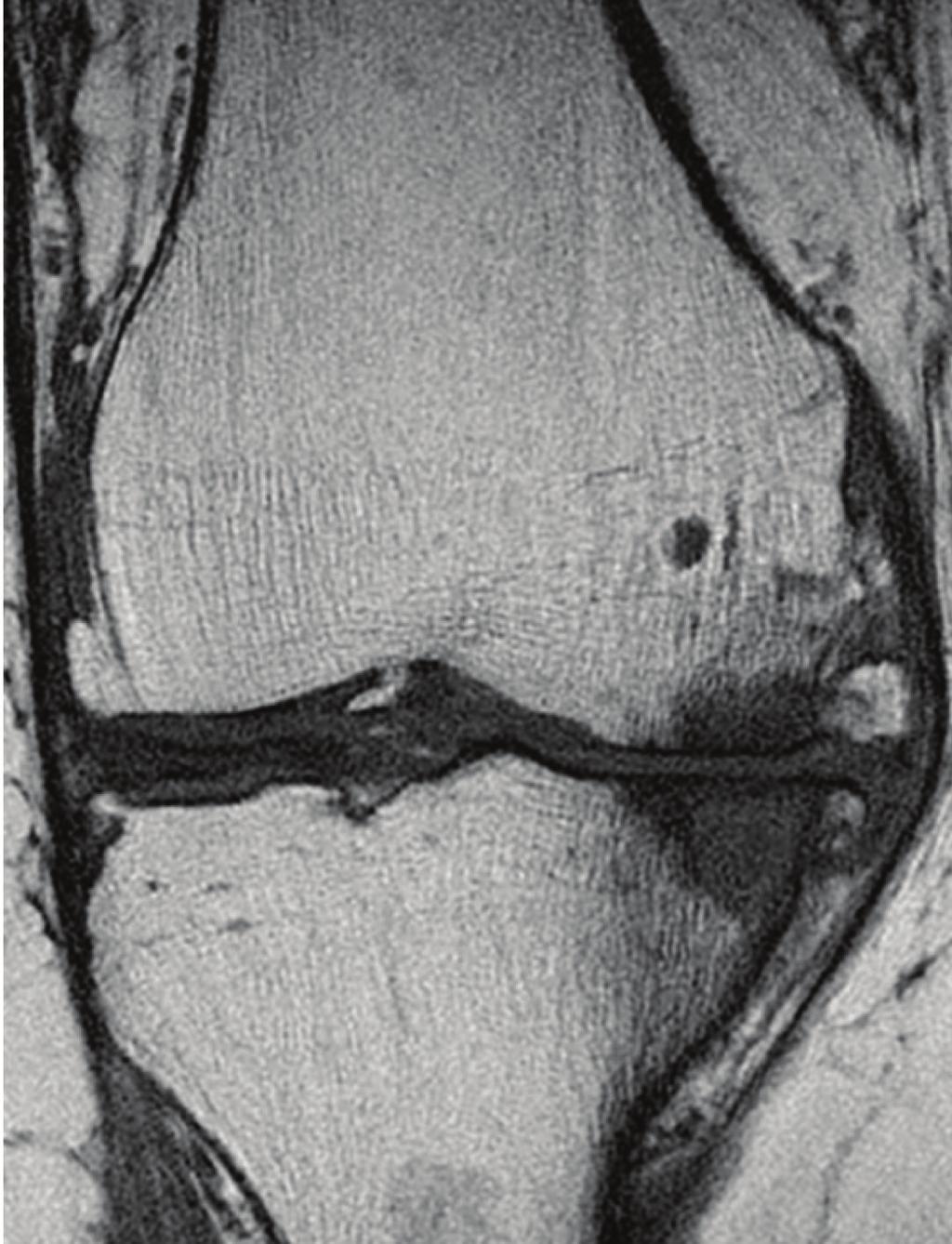 4 Case Reports in Orthopedics (a) (b) (c) Figure 3: (a) Coronal T1 MRI with contrast image in painful knee OA patient showing large
