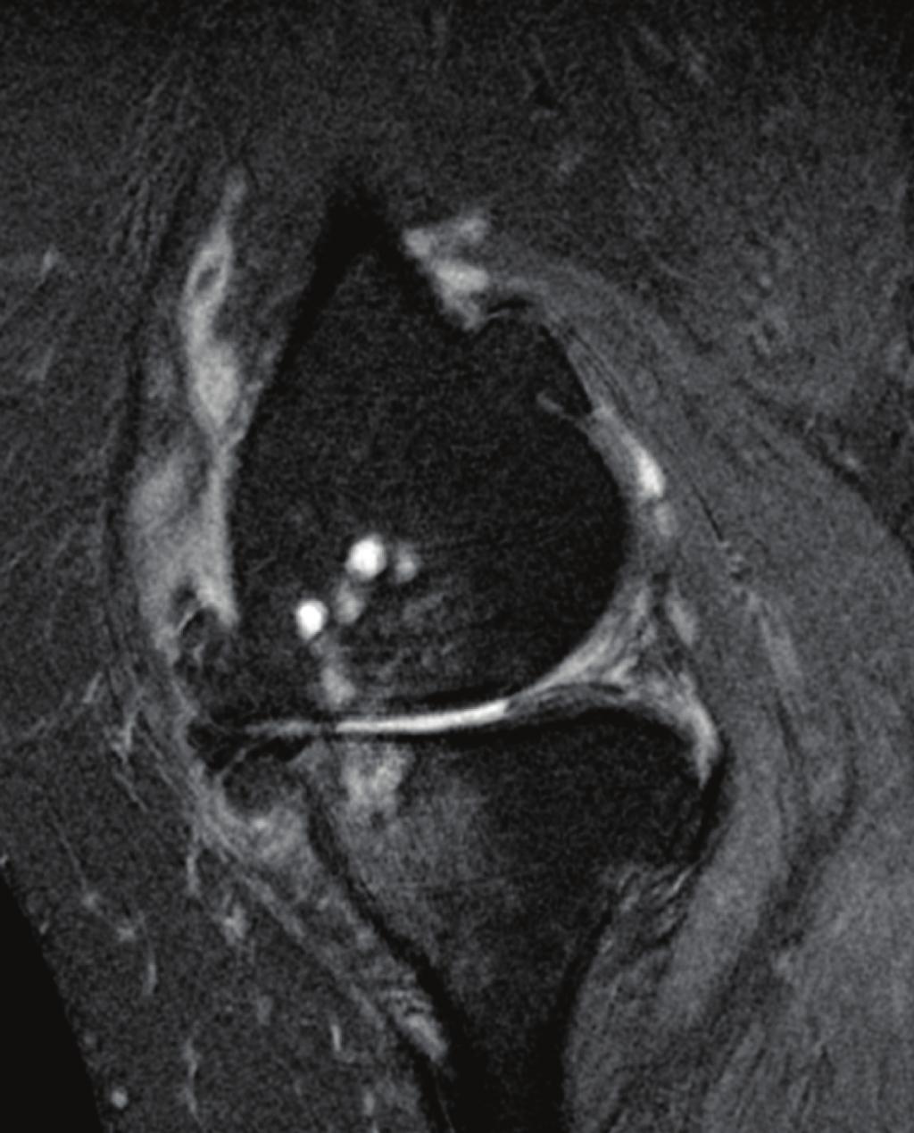 (b) Corresponding proton density weighted fat suppressed sagittal MRI sequence showing the large anteromedial BML (green arrow).