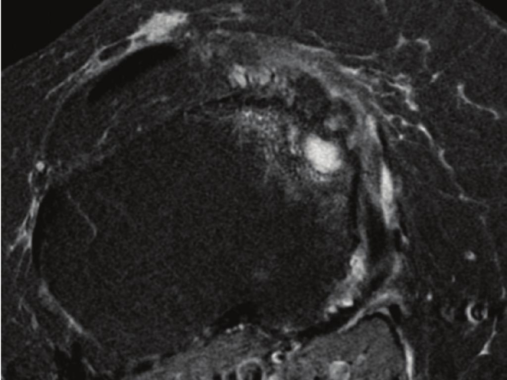 Figure 4: Coronal and Sagittal MAVRIC STIR SLR MRI showing complete resection and resolution of BMLs 12 months after TKR surgery (blue