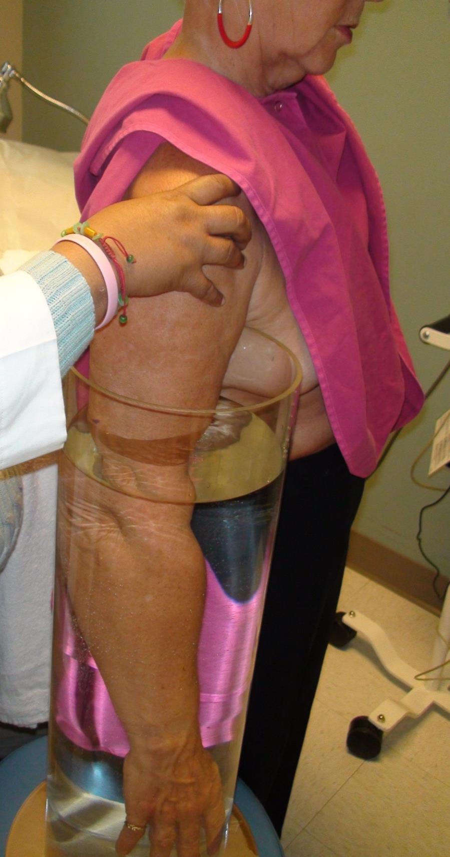 Lymphedema Evaluation Water volume displacement: Volumeter filled with water 10 cm Above the Elbow