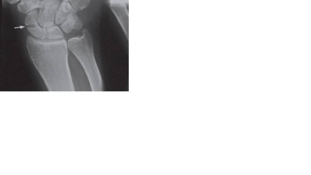 Occult Scaphoid Fracture 2 months