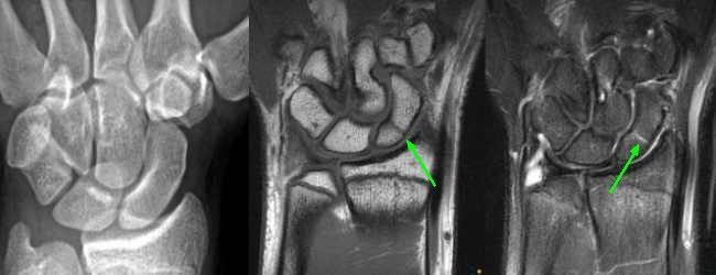 Occult Scaphoid Fracture MRI Can differentiate sprain from scaphoid fracture in acute evaluation Useful for athletes, musicians,