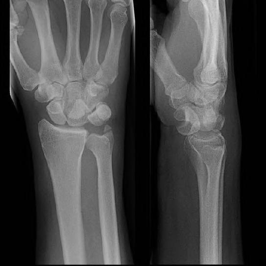 Perilunate Dislocation Spectrum of traumatic instability that may involve bony or purely ligamentous injury How not to miss: Patient will have significant pain and swelling Careful attention to XR