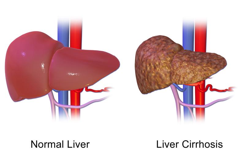 » Occurs when normal tissue replaced by scarred tissue» Many Causes: Alcohol, Hepatitis B or C, Fatty liver (NAFLD/NASH),
