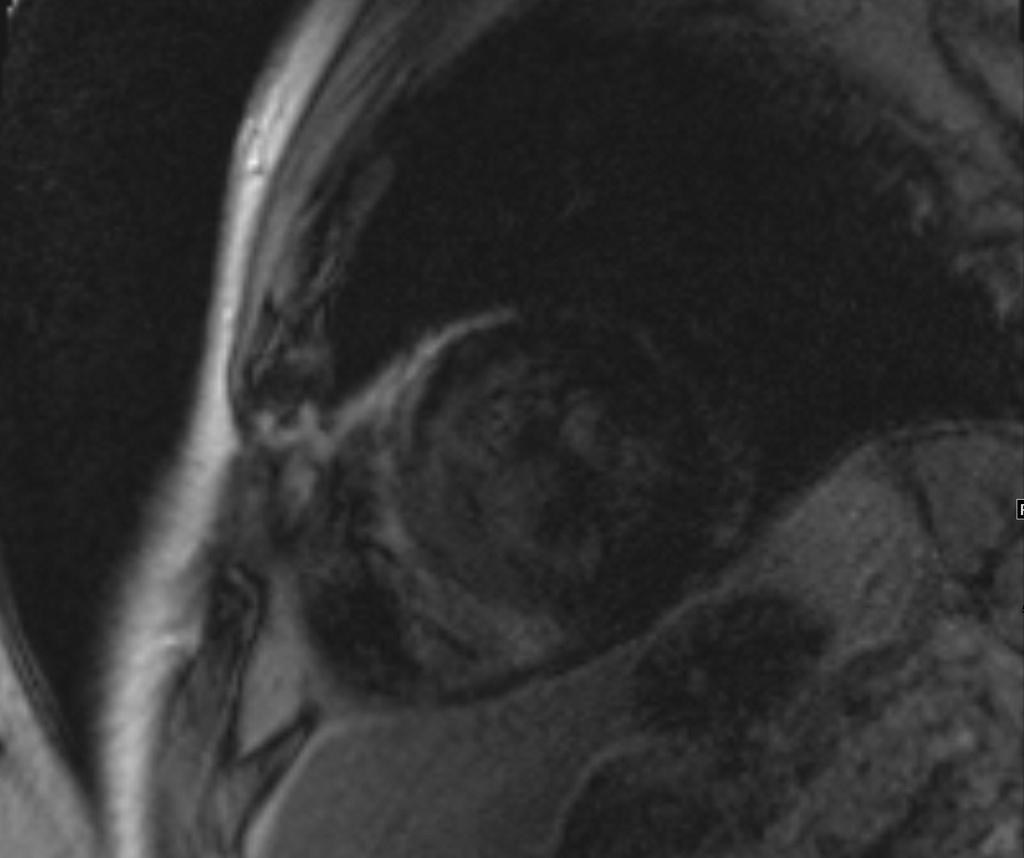 Figure 3a. Cardiac amyloidosis in a 75-year-old man with multiple myeloma.